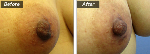 分裂乳頭の手術による症例写真