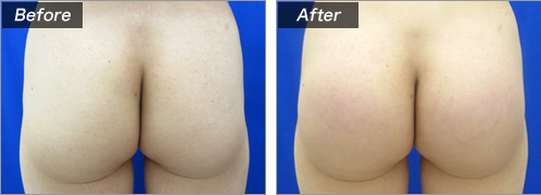 豊尻術による症例写真　正面