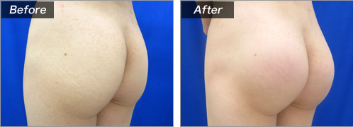 豊尻術による症例写真　横